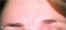 Before a treatment with Botox for wrinkles.