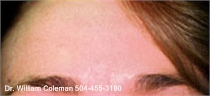 After a treatment with Botox for wrinkles.