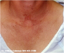 Before Chemical Peel Chest procedure