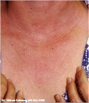 After Chest Chemical Peel