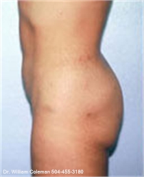Liposuction treatment of the abdomen after