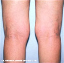 Before Knee Liposuction New Orleans