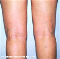 After knee Liposuction New Orleans