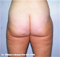 After thigh Liposuction New Orleans