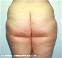 Before Liposuction Thighs New Orleans