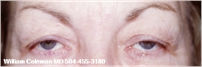 Before Eyelid Surgery New Orleans