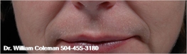 Before Fillers are used to treat wrinkles