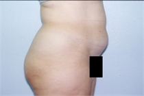 Before Abdominal Liposuction New Orleans